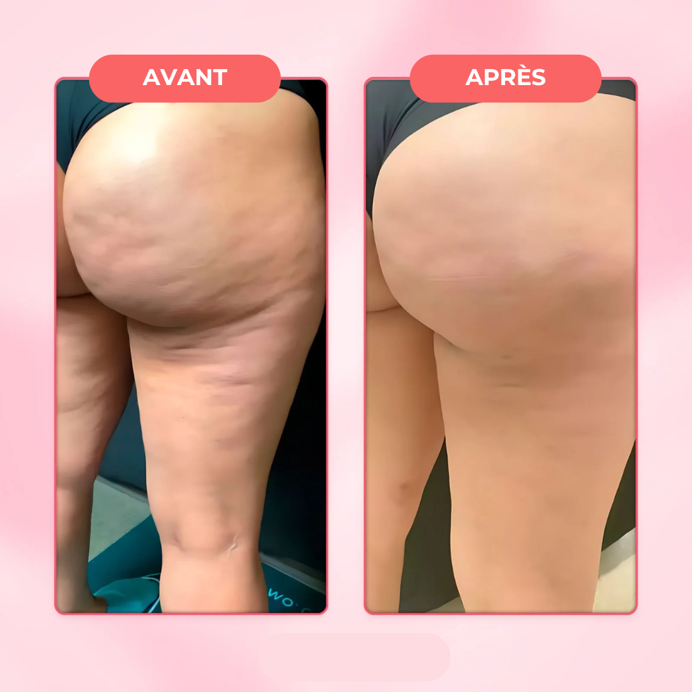 Appareil de massage anti-cellulite - Celliova