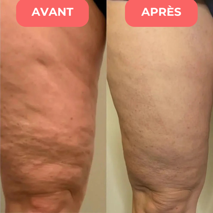 Appareil de massage anti-cellulite - Celliova